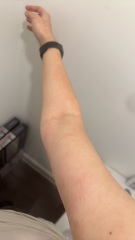 Potential Eczema?