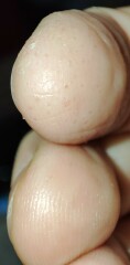 Hand eczema/pompholyx . Help! Trying to wean off steroid but keep reflaring!