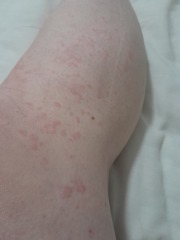 Rash/hives