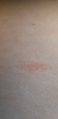 Photos - my abdomen