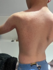 Rash