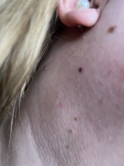 To think this is melanoma