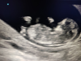 Poll: Gender prediction (nub theory?) +/- 12w, I'm beyond curious. Will confirm in 3 weeks.