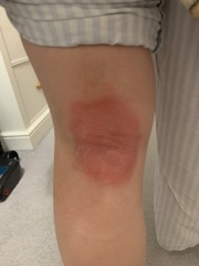 Rash on leg