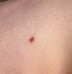 Could this be skin cancer ???