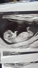 nub/skull  for 12weeks scan guess boy or girl
