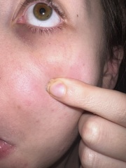 Petachaie / blood spots around eyes.. advice