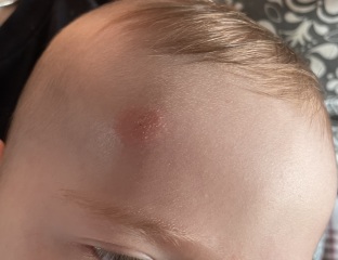What is this rash?