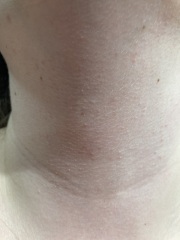 Spots on chest and neck advice please