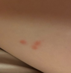 Spots? Bites? What are these?