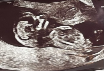 July / August babies let’s see your scans!
