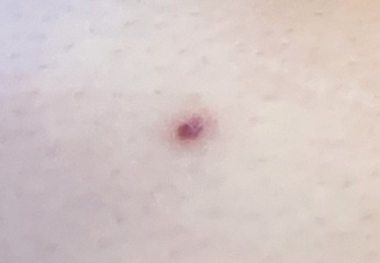 Could this be skin cancer ???