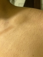 What is this swelling above my collar bone.