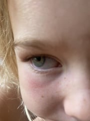 Red skin below dd's eyes