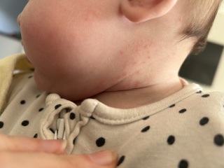 Baby potential egg allergy