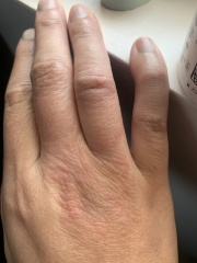 Hand eczema/pompholyx . Help! Trying to wean off steroid but keep reflaring!