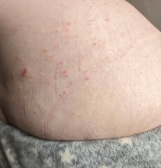 Could this be scabies?