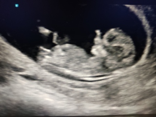 Poll: Gender prediction (nub theory?) +/- 12w, I'm beyond curious. Will confirm in 3 weeks.