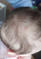 Cradle cap or eczema???