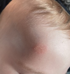 What is this rash?