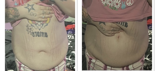 Thyroid and Pregnancy