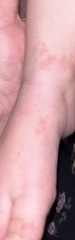 Can anyone help? No idea what this rash is