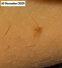 They postponed my appointment with the dermatologist 3 times. I don’t know what to do with this mole!