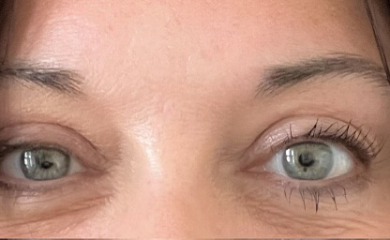 Botox is it worth it?