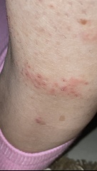 I have folliculitis on my lower left leg, and some red freckles on my right leg? Is this cause for concern?