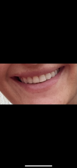 Braces in 30s?