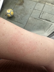 What this come up on my arm pics