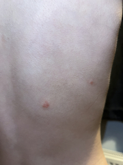 Can anyone identify this rash?