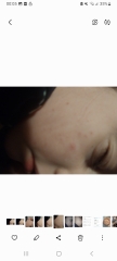 Could this be scabies!?