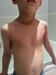 Rash