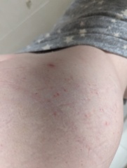 Could this be scabies?