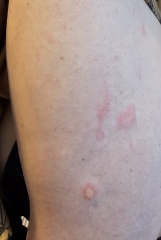 Does this look like shingles?