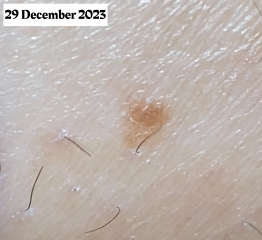 They postponed my appointment with the dermatologist 3 times. I don’t know what to do with this mole!