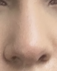 Non-surgical rhinoplasty