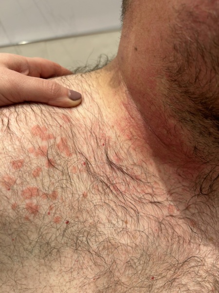 Scarlet fever?