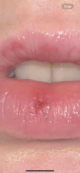 Have I given Dh genital herpes? Feel so stupid