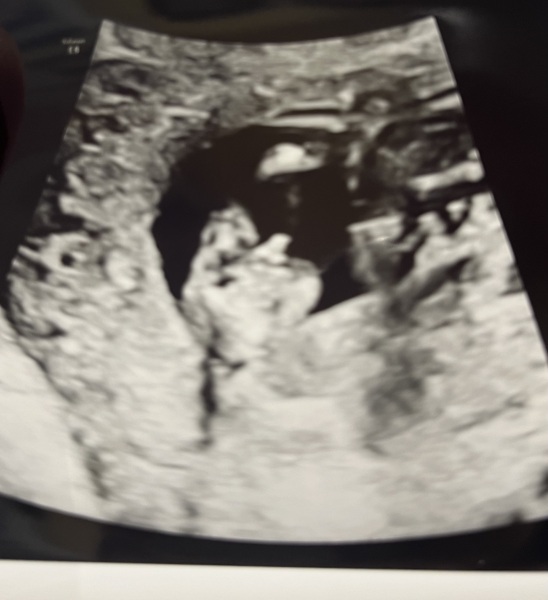 12 weeks scan - sonographer said boy, could she be wrong?