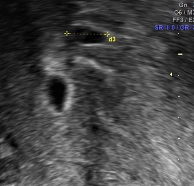 5 weeks 2 days scan