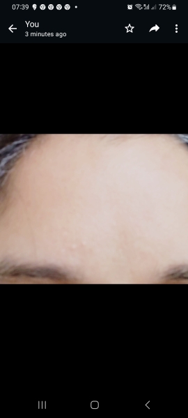 Botox, how mainstream is it and what do you think of those who use it?