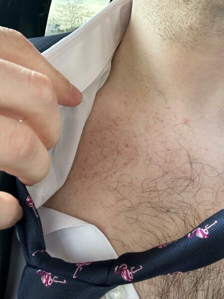 Non-blanching rash
