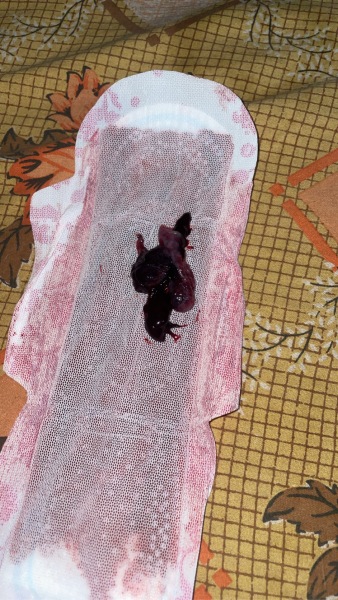 Miscarriage or blood clot