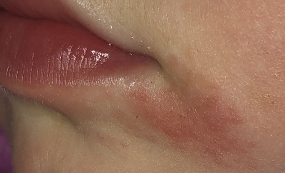 To ask if this looks like impetigo or just an allergic reaction?