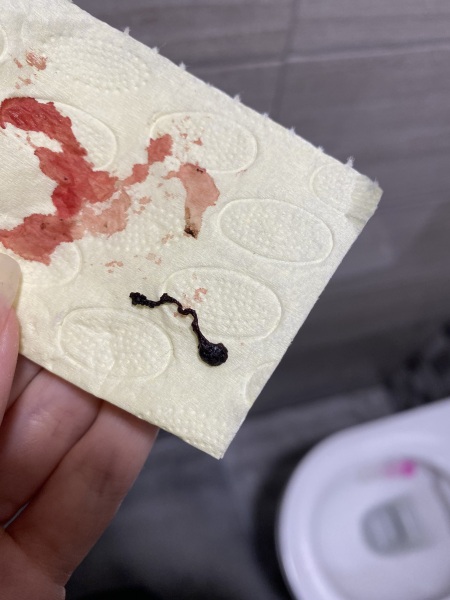 Spotting before miscarriage