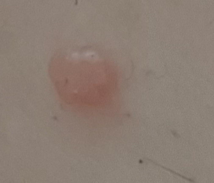 Ingrown pubic hair? What can I do. Pic.