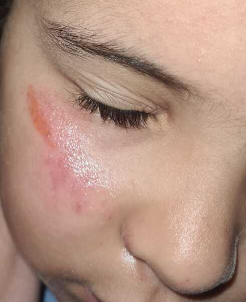 School injury with photo