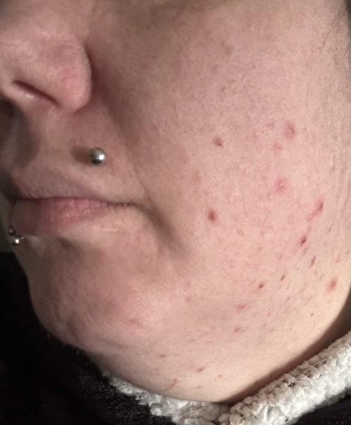 Liz Earle causing spots!